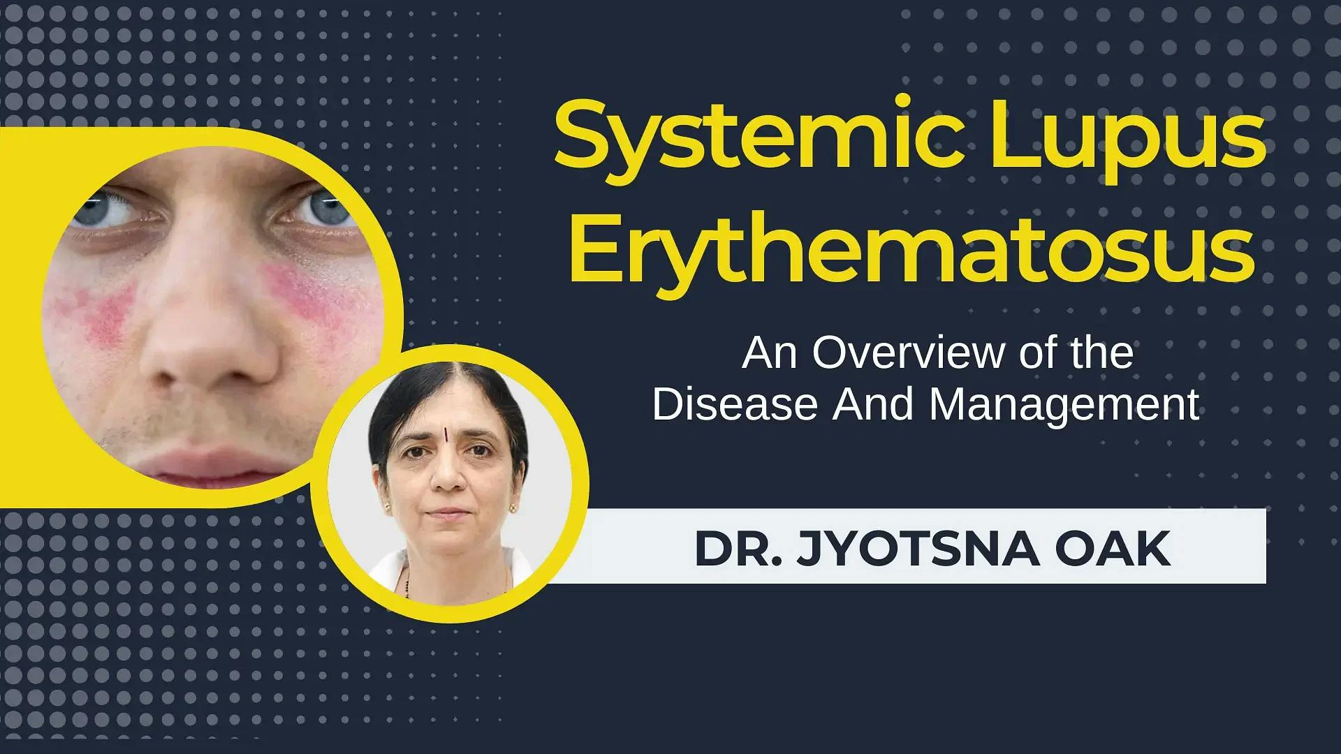Systemic Lupus Erythematosus: An Overview of the Disease And Management 