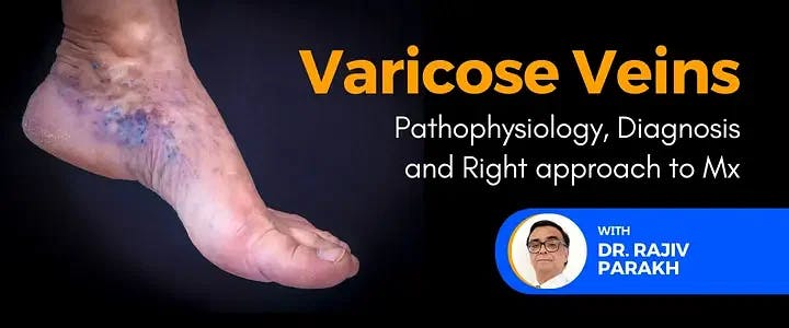 Varicose Veins: Pathophysiology, Diagnosis and Right approach to Mx