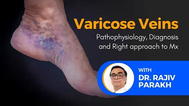 Varicose Veins: Pathophysiology, Diagnosis and Right approach to Mx